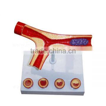 Thrombus Education Biological Teaching Human Body Anatomy Model photo-3