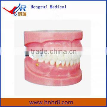 Periodontal Disease Demonstration Dental Education Model