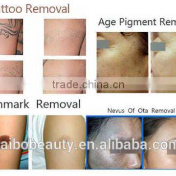 Big Spot Size !!! Beauty Laser Tattoo Removal Equipment/tattoo Removal Laser Equipment
