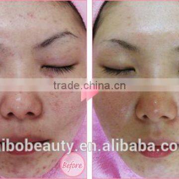 Best Dermabrasion and Microdermabrasion Face Cleaning Peeling Machine for Beauty Salon photo-6