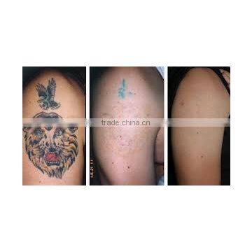 Brown Age Spots Removal Q-Switch ND Yag Laser Machine For Laser Tattoo Removal Or Birthmark Removal With Medical CE Mongolian Spots Removal