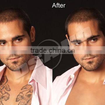 800mj Body Tattoo Removal Q 1 HZ Switched Nd Yag Laser Machine 0.5HZ photo-5