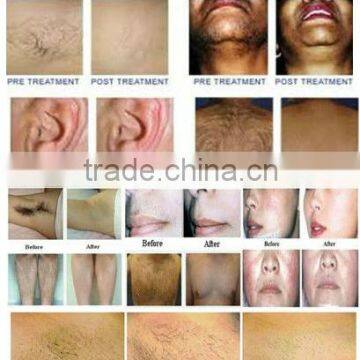 Portable Personal Laser Hair Removal Machine/ Laser Hair Removal Machine/ Home Laser Hair Removal Machine photo-6