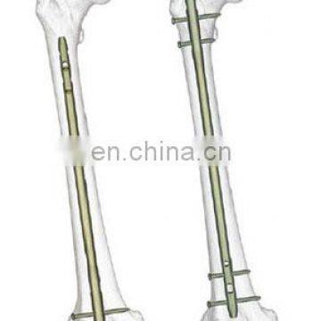 Humerus Interlocking Nail photo-4