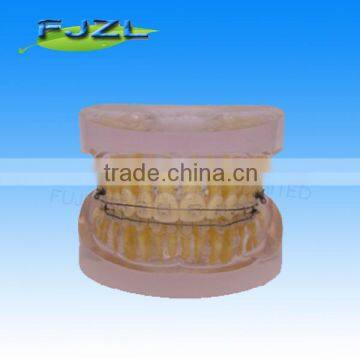 orthodontic teeth model(Transparent model , dislocation tooth, common brackets),dental orthodontic models