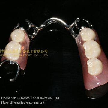 Dental Co-Cr Partial Denture,Titanium Framework Denture, Dental Dentures, Laboratoire Dentaire, Dentallabor, Laboratorio Dental, Dental Laboratory, Shenzhen LJ Dental Lab China photo-4