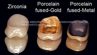High Strength Yellow Gold Porcelain Dental Crown PFM Ceramic Crown