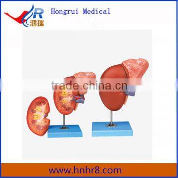 Medical Human Enlarged Kidney and Adrenal Gland Anatomical Model