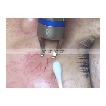 980nm diode laser vascular removal