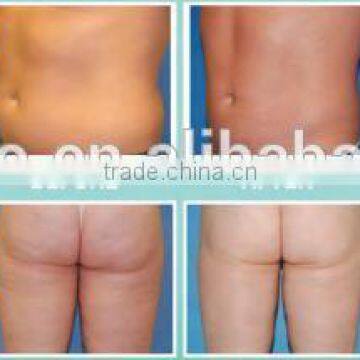 We Need Distributors 4 Handles OSANO Body Shape Vaser Liposuction Machine For Sale photo-6