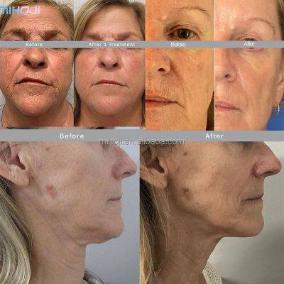 CE EEC FDA 2024 Morpheus 8 Beauty Machine With Ice Hammer photo-2