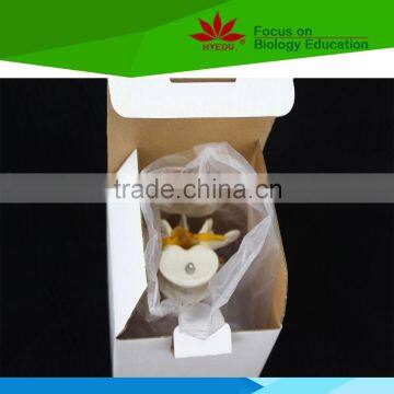 High Quality for Medical Educational Supply 2 Lumbar Vertebrae Skeleton Model With Hernia and Prolapsed Intervertebral Disc