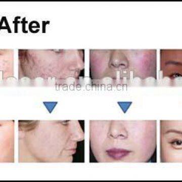 Shr YAG Laser Hair Removal Tattoo Removal Beauty photo-2