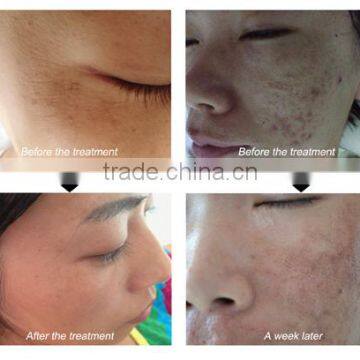 2015 Most Popular Fractional rf Beauty Device for All Kinds Wrinkle Remomal