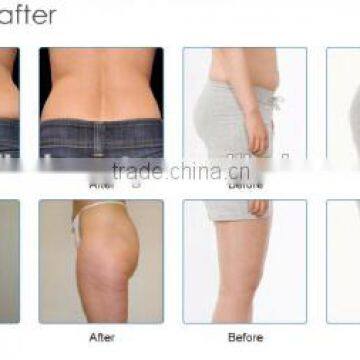 Cellulite Reduction Lipo Laser Machine/weight Loss Products Best Lipo Laser Machine