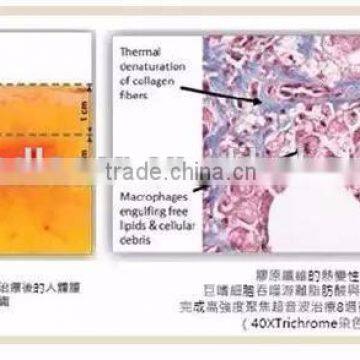 2016 Best Selling Body Slimming Beauty Machine Liposonix Machine Loss Weight photo-6