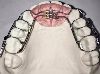 Orthodontic Hawley Retainer From China Dental Lab