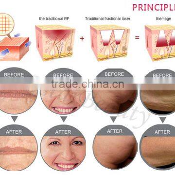 Microremage RF ThermaCool Equipment MR 01 photo-6