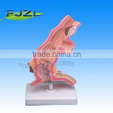 human anatomy Diseased Esophagus Model