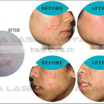 Kiyalaser Manufacturer! Acne Treatment Products