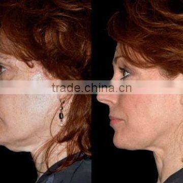 RF Fractional Micro Needle / Fractional rf Microneedle / Fractional rf Microneedle Machine photo-5