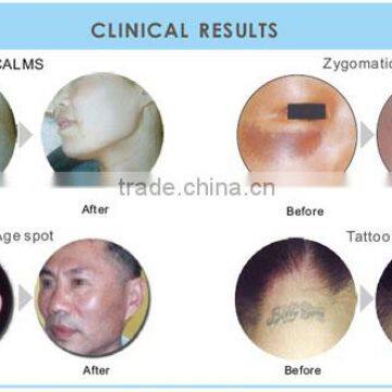 Whiten Body Machine nd Yag Laser Particular for Colour Removal 2016 Hot Sale photo-3