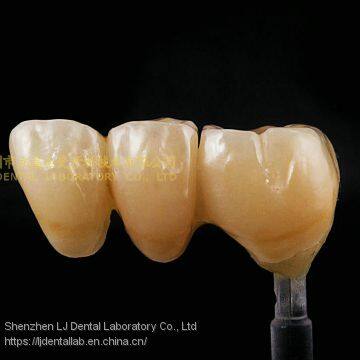 Dental Crown Zirconia Cercon,dental Teeth,dental Prosthesis Laboratoire Dentaire, Dentallabor, Laboratorio Dental, Dental Laboratory, Shenzhen LJ Dental Lab photo-3