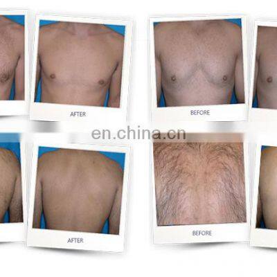 2022 Newest Diode Laser 808nm Alma Sopran Ice Platinum Hair Removal Machine Diode Laser for Hair Removal photo-5