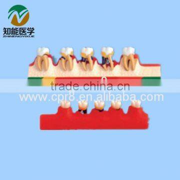 Periodontal disease classification model BIX - L1010