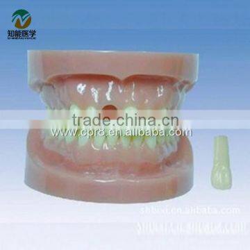 BIX - L1019 Removable no root standard tooth model