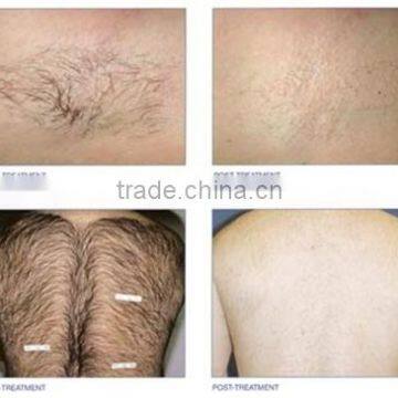 Cheap Portable Nubway Beauty Laser Hair Remover 808 photo-3