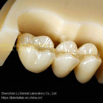 Dental crown multilayer zirconia, dental teeth, dental prosthesis, laboratoire dentaire, Dentallabor, laboratorio dental, dental laboratory, Shenzhen LJ dental lab