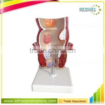 Rectum Pathology Organs Education Human Body Anatomy Model