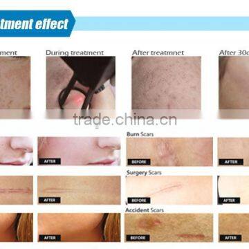 2016 CE Approved Verticalsuper Pulse Co2 Fractional Laser for Laser Scar photo-4