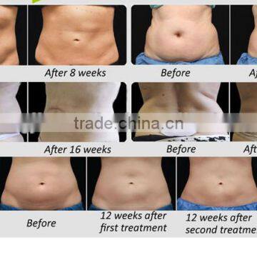 Cryolipolysis Slimming Machine/fat Body Slimming Freezing Cryolipolysis/cryolipolysis Machine Body Shaping photo-4