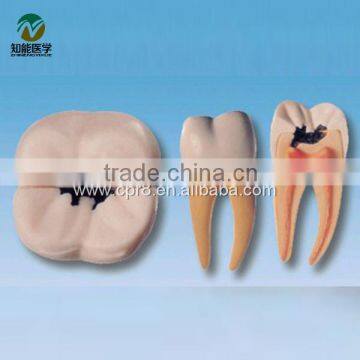 BIX-L1002 On the right side of the first molar tooth decay model