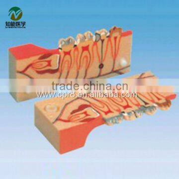 BIX-L1003 Tooth decomposition model of the organization