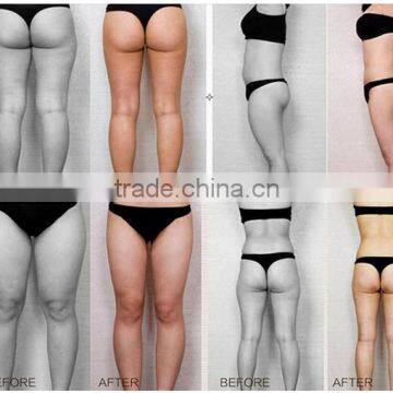 Safety Ultrasound Slimming Weight Loss Fat Reduction Liposunic Machine Price photo-4