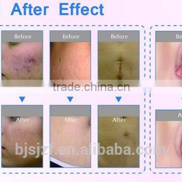 F7+ Laser Vaginal Tigntening Scar Removal Skin Rejuvenation photo-4