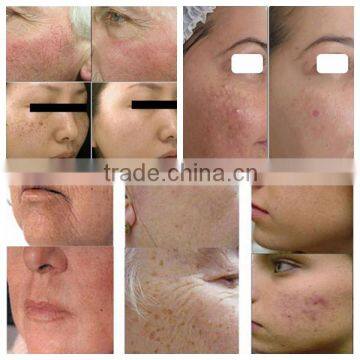 2016 Most Popular Beauty Equipment New Style SHR /IPL+elight Multifunctional IPL SHR photo-5