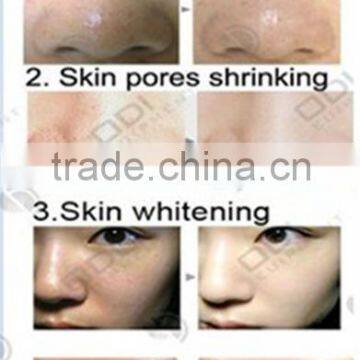 China Factory Best Black Doll Skin Rejuvenationcarbon Powder 50g Acne Treatment Laser Carbon Lotion photo-6