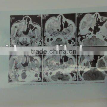 transparent conductive film,Konida Medical laser blue film used by Epson printer