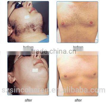 NYC (opt Technology ) Laser Hair Removal and Skin Rejuvenation Machine photo-4