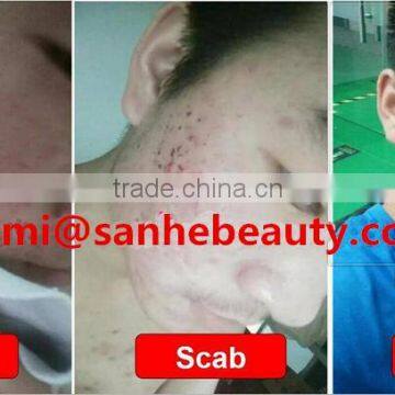 High Quality 10600nm Co2 Laser / RF Co2 Fractional Laser / Fractional Laser Co2 photo-6