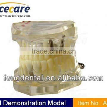 Hot sale and high quality Implant Series Implant model with restoration AC-P6