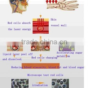 Cholesterol and blood clots cleaner laser therapy watch