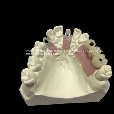 Dental-Implants china outsourcing dental lab