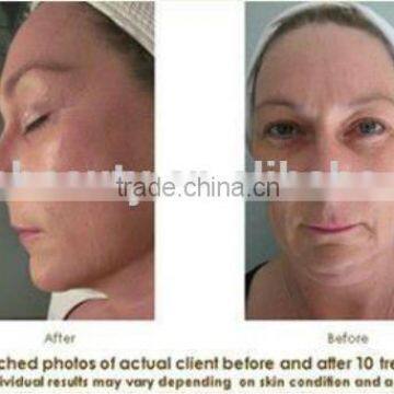 NV-17 Beauty Cosmetics Microdermabrasion Machine Diamond Dermabrasion for Skin Lifting photo-5