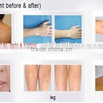 Double Handles Professional Laser Hair Removal Machinewith CE Approved photo-3
