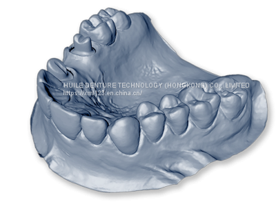 CAD/CAM dental PFM crown from China dental lab